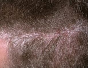 Psoriasis-Krankheit der Kopfhaut und der Kopfhaut, Foto des Anfangsstadiums