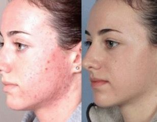 Foto der Gesichtshaut nach der Behandlung von Psoriasis