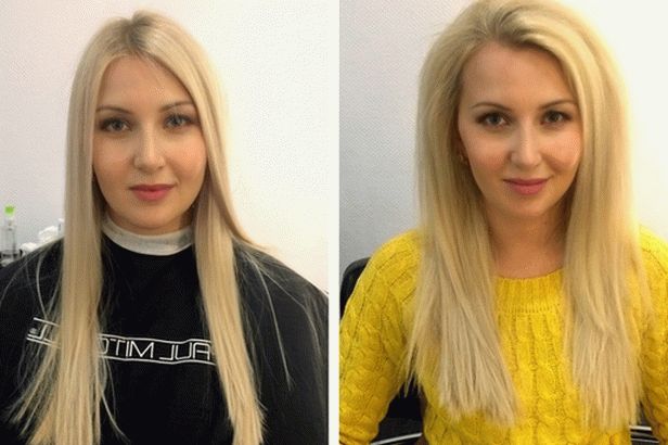 Basal Volume Boost Up