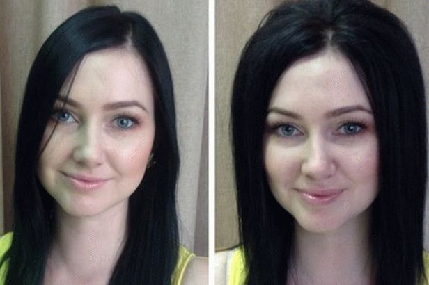 Basal Volume Boost Up