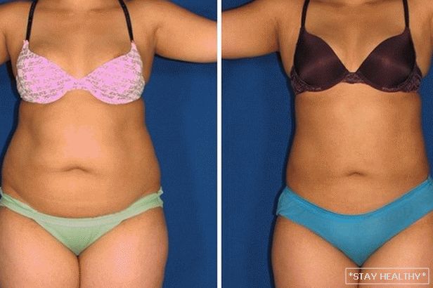 Фото похудения до и после